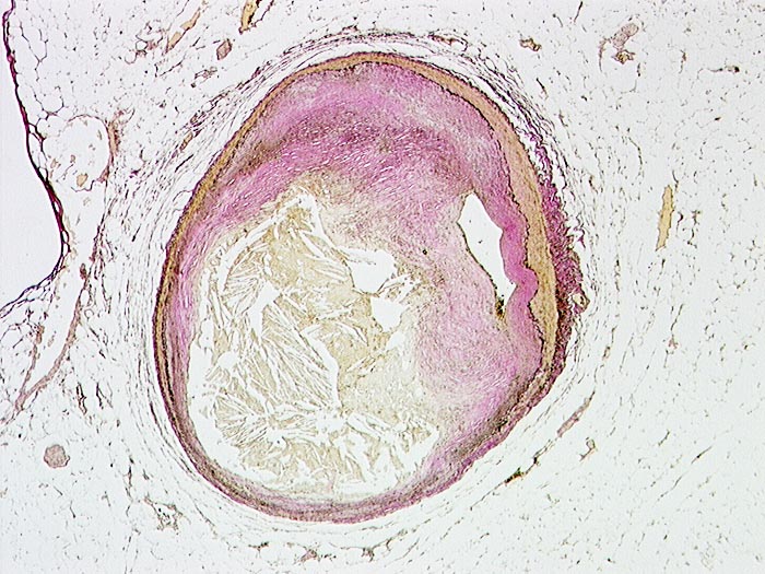 Тромб микропрепарат. Белый тромб микропрепарат. Тромбофлебит гистология. Атеросклероз венечной артерии гистология. Белый тромб макропрепарат.